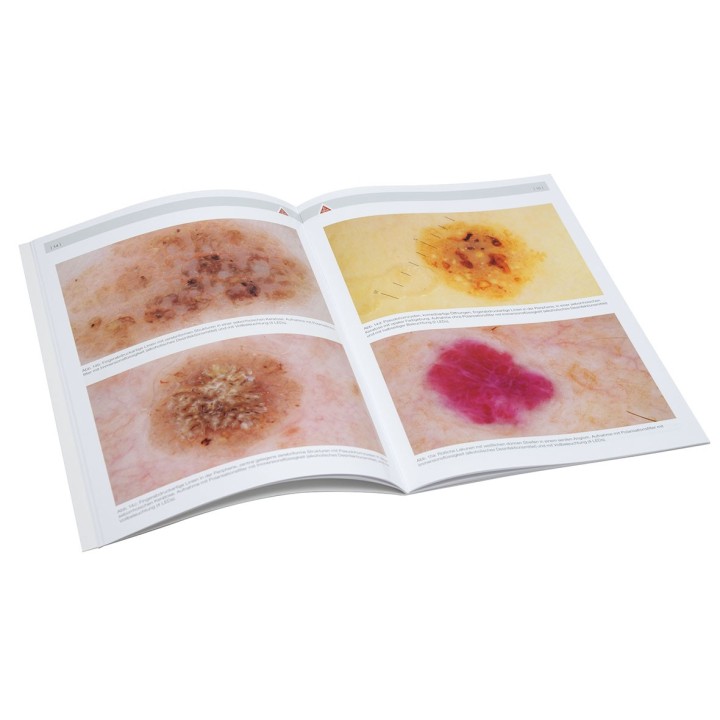 HEINE dermatoscopy compendium